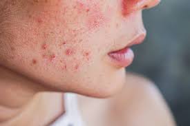 Acne is a skin disorder affected by gut health