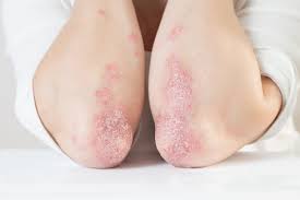 Psoriasis is one of the skin disorders impacted by gut health